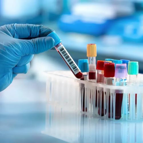 Un análisis de sangre permite diagnosticar el alzhéimer con una precisión del 95 %