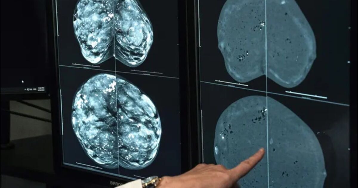 La FDA aprueba la primera herramienta de IA para predecir el riesgo de cáncer de mama