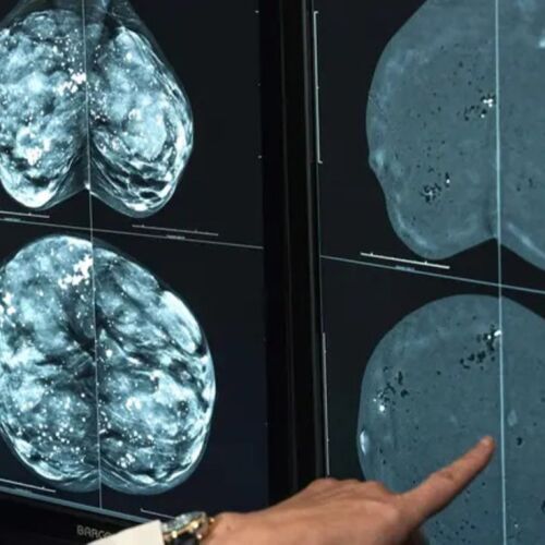 La FDA aprueba la primera herramienta de IA para predecir el riesgo de cáncer de mama