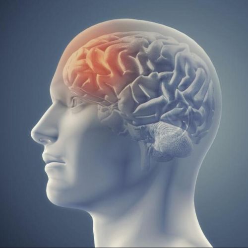 Nuevo examen para detectar derrames cerebrales